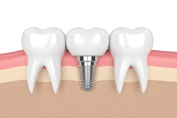 Success Rate Of Dental Implants